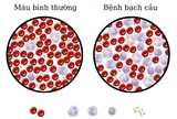 Điều trị bệnh bạch cầu bằng tế bào gốc trung mô