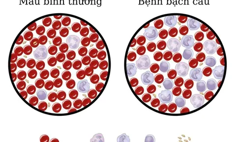 Điều trị bệnh bạch cầu bằng tế bào gốc trung mô