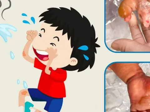 Con bị bỏng, cha mẹ vô tình làm hại con chỉ vì nghe lời người quen