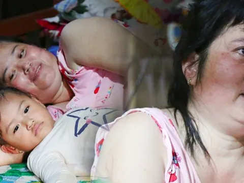 Đường cùng của người mẹ bị hoại tử xương, cầu mong sống tiếp để nhìn con gái 3 tuổi