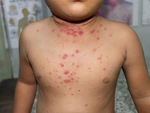 Mỹ phát hiện trẻ sơ sinh mắc bệnh đậu mùa khỉ