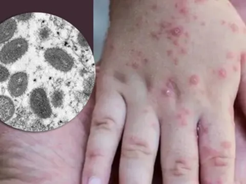 Bộ Y tế khuyến cáo cách phòng, chống bệnh đậu mùa khỉ