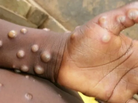 Những điều cần "bỏ túi" về đậu mùa khỉ, tránh lo lắng thái quá