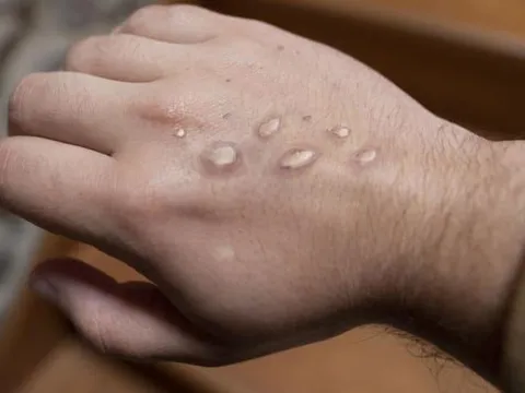 TP HCM tăng cường triển khai các giải pháp giám sát bệnh đậu mùa khỉ