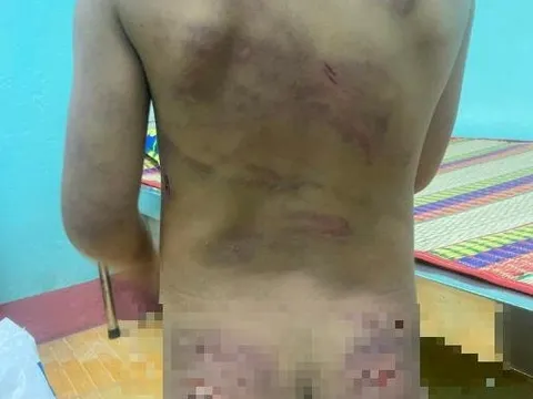 Bé gái mang đầy vết thương gây dậy sóng mạng xã hội ở cùng mẹ và cha dượng