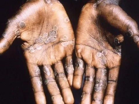 Bệnh đậu mùa khỉ: Những ai dễ mắc, dễ bị nặng và tử vong?