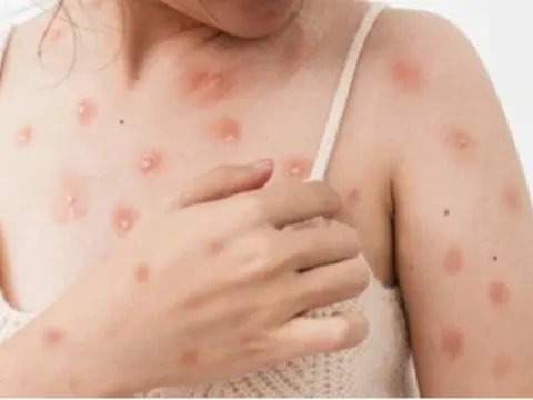 Chuyên gia nói gì về việc cách ly y tế đối với bệnh nhân mắc đậu mùa