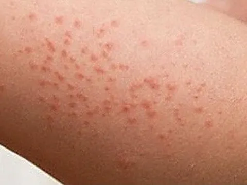 Cảnh giác bệnh sốt xuất huyết 'giả dạng' viêm hô hấp trên