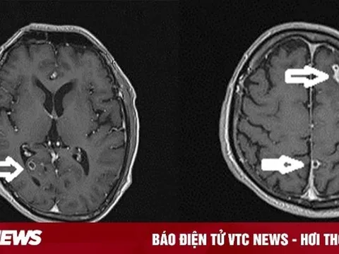 Kinh hãi sán làm tổ trong não người phụ nữ