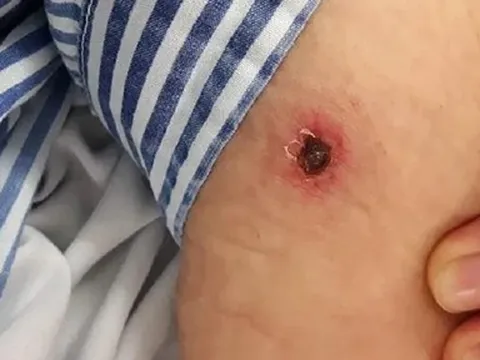 Liên tiếp phát hiện các trường hợp bị sốt mò, cần ghi nhớ những điều này để phòng bệnh