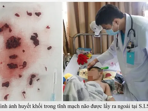 Rút hàng chục cục máu trong não bé trai từng mắc Covid-19