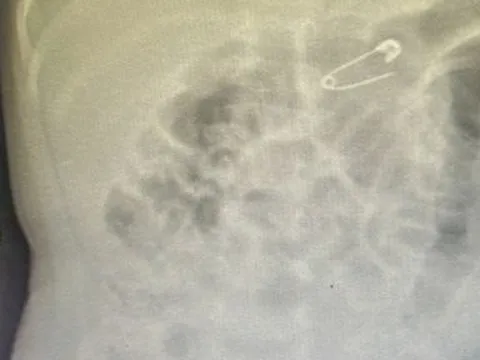 Cháu bé 6 tháng tuổi suýt bị kim băng "phong thủy" đâm thủng dạ dày