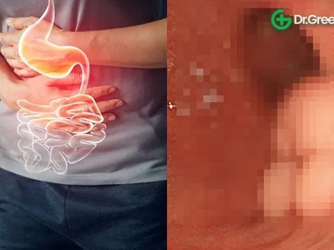 Bị ung thư dạ dày nhưng từ chối phẫu thuật vì 'sợ': Bỏ lỡ giai đoạn vàng điều trị bệnh