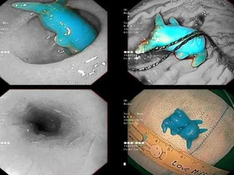 Đồ chơi Pikachu kẹt trong thực quản bé trai 6 tuổi