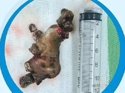 Nghệ An: Lấy viên sỏi san hô “khủng” từ bụng người đàn ông 58 tuổi