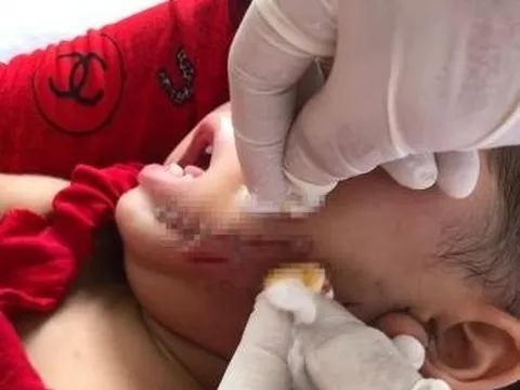 Cà Mau: Bé gái 19 tháng tuổi bị chó dại cắn vào mặt