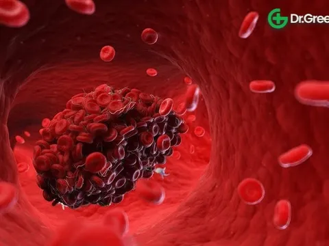 Dấu hiệu cảnh báo có cục máu đông trong cơ thể: Ai là người cần lưu ý?