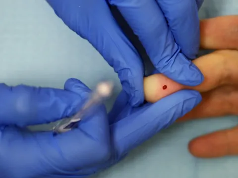 Xét nghiệm thấy điều này, cẩn thận đột quỵ trước 60 tuổi