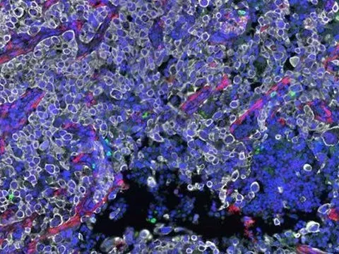 Đột phá: Thuốc mới đánh bại cả tế bào ung thư tàng hình