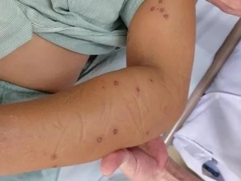 Cô gái 28 tuổi nguy kịch vì bị ong vò vẽ tấn công