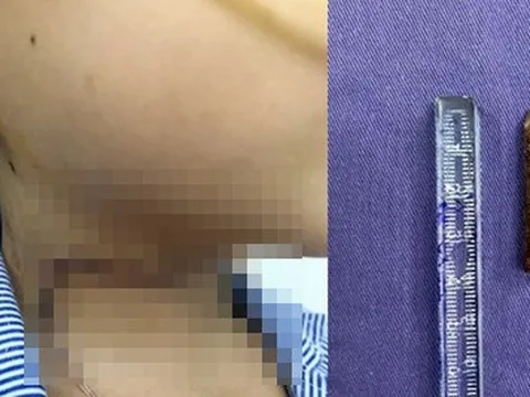 Liên tiếp tai nạn thương tích ở trẻ: Chuyên gia chỉ cách phòng tránh