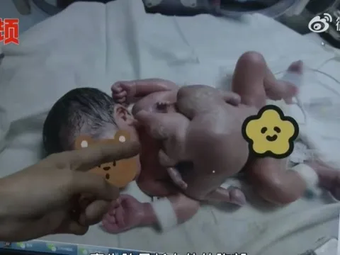 Bé sơ sinh 4 tay 4 chân vô cùng hiếm gặp