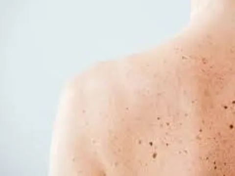 Dấu hiệu ung thư bị nhầm tưởng: Làm thế nào để phân biệt?