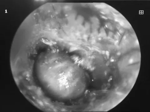 Bác sĩ gắp được ve chó còn sống trong tai bé gái 2 tuổi