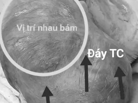 Cứu sống sản phụ mang thai ở góc tử cung hiếm gặp