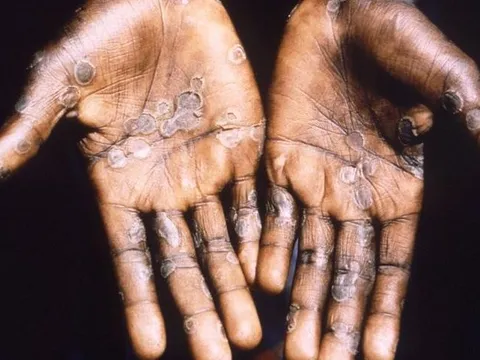 TP HCM có ca bệnh đậu mùa khỉ đầu tiên