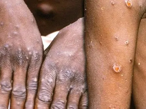 Đậu mùa khỉ xuất hiện tại Việt Nam: Chuyên gia phân tích và chỉ cách phòng ngừa