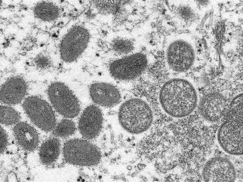 Bệnh đậu mùa khỉ lây truyền qua những đường nào?