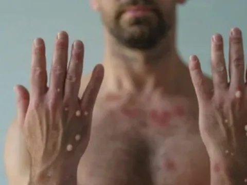 Chuyên gia chỉ rõ điểm khác biệt để phân biệt đậu mùa khỉ và thủy đậu