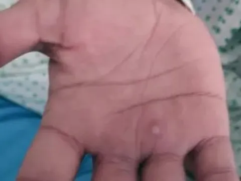 Ai có nguy cơ cao mắc bệnh đậu mùa khỉ?