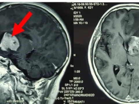 Đau đầu dai dẳng, đi khám phát hiện nguyên nhân đáng sợ trong não