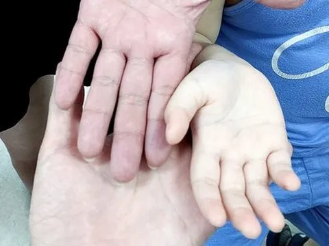 Bé trai mũm mĩm nhưng hay ốm, có bàn tay trắng toát khác thường: Bác sĩ chỉ ra nguyên nhân