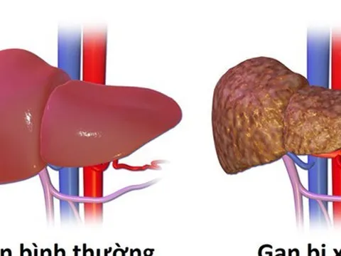 Ai là người dễ mắc bệnh ung thư gan?