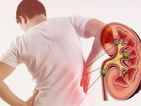 Những thói quen tệ hại “hành hạ” thận nhiều người Việt mắc phải