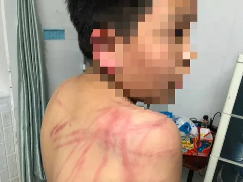 Lãnh đạo TP Đà Lạt thăm hỏi cháu trai 10 tuổi bị cha bạo hành dã man