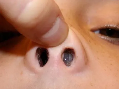 Ngạt tắc mũi tăng dần cảnh giác ung thư vùng mũi xoang