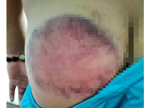 Học sinh tiểu học bị giáo viên đánh bầm tím mông vì nghịch, quên mang sách