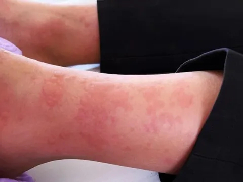 Trên đường đi học về, bé trai 12 tuổi bị ong mặt quỷ đốt nguy kịch