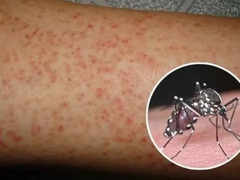 3 món ăn hỗ trợ người bệnh sốt xuất huyết phục hồi tốt