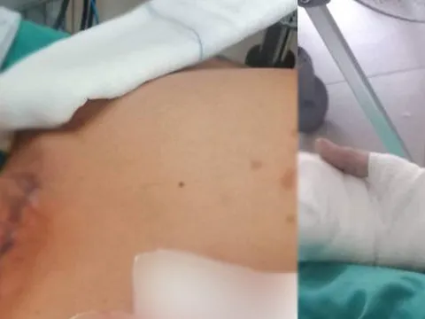 Bị dây diều cứa rách cổ khi đang chạy xe máy trên cầu Thủ Thiêm 1