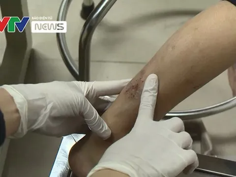 8 lời khuyên giúp phòng ngừa viêm da cơ địa mùa khô hanh