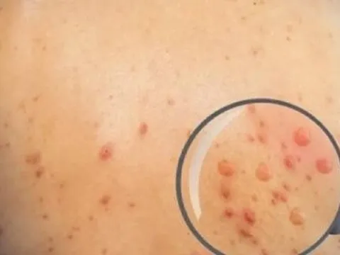 Ghi nhận một trường hợp trở về từ Nam Phi nghi mắc đậu mùa khỉ