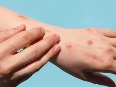 Phát hiện một ca nghi mắc đậu mùa khỉ tại Đắk Lắk, Bộ Y tế chỉ đạo khẩn