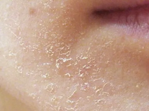 Da khô, nứt nẻ mùa lạnh, bác sĩ bày cách xử lý