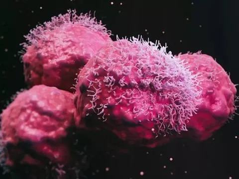 Người phụ nữ được chẩn đoán mắc 12 khối u có đột biến gien chưa từng thấy ở người