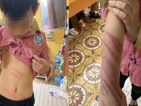 Hải Phòng: Làm rõ vụ bé trai 8 tuổi bị bạn trai của mẹ bạo hành